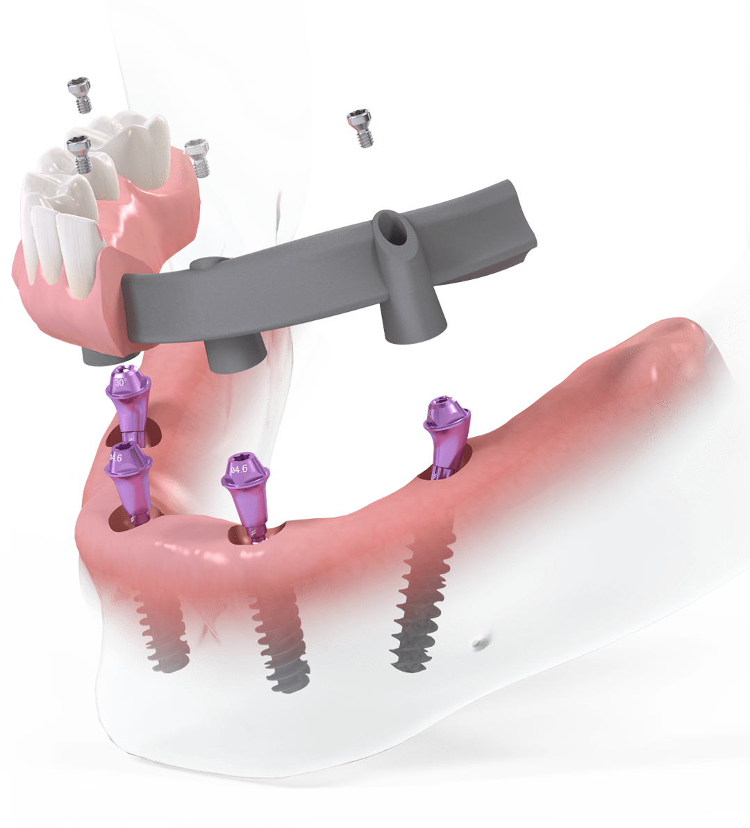 Implantatbehandlungen am selben Tag