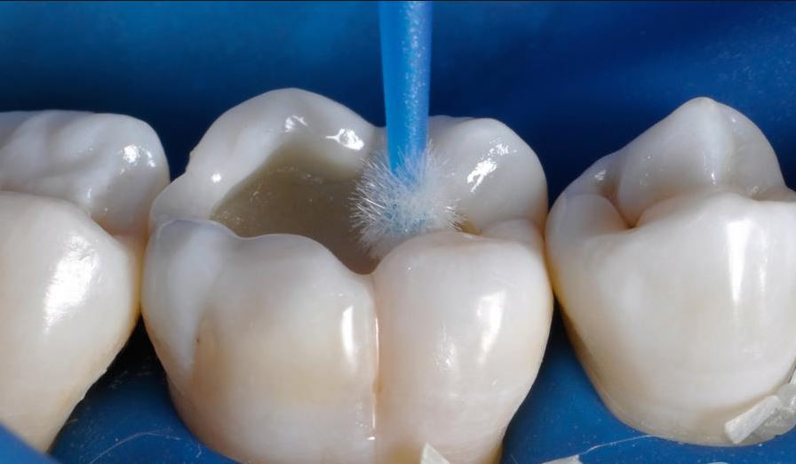 In this process, only a small amount of enamel must be removed, and your tooth structure is preserved.