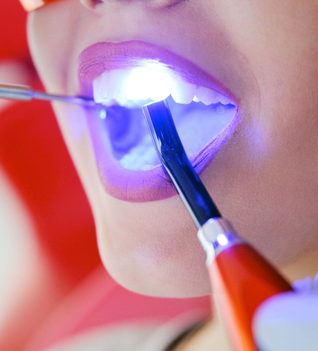 Composite bonding how our dentist uses UV cured resins