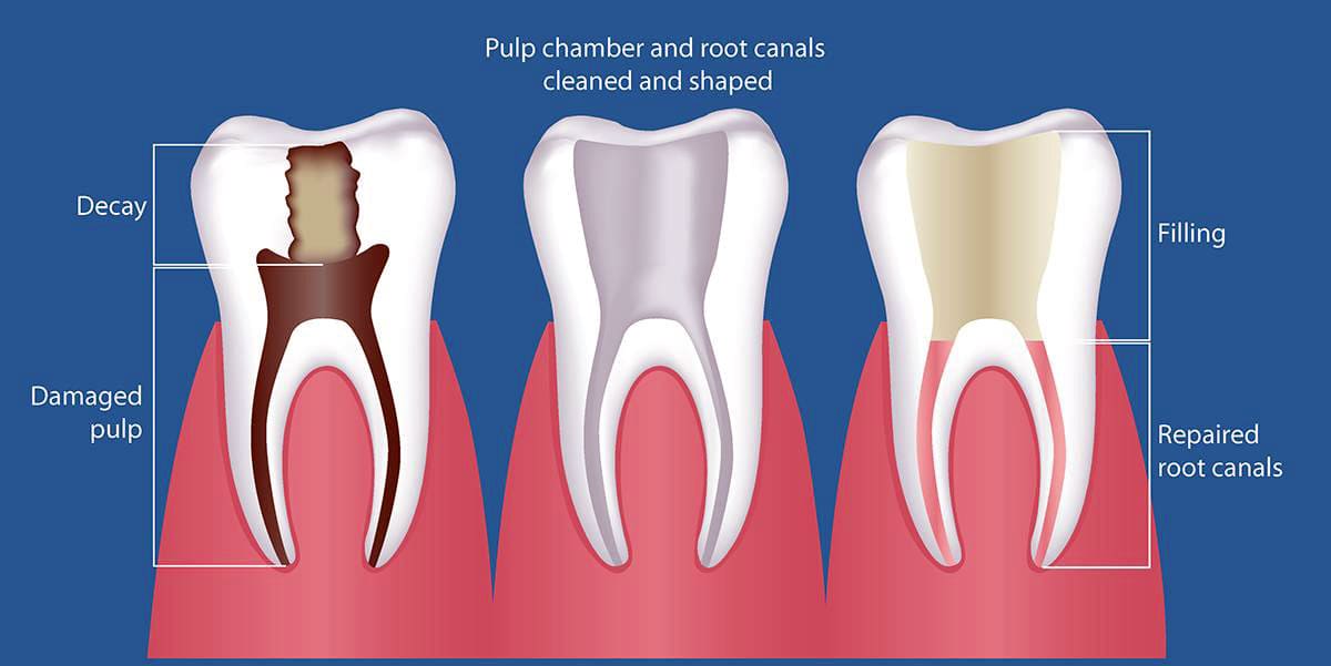 Sealing the root canals to prevent further decay